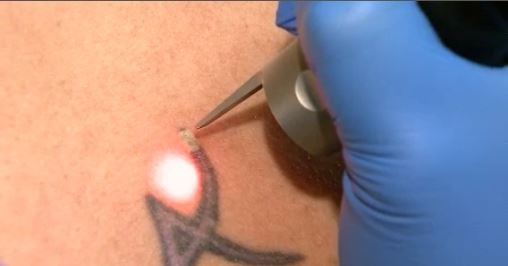 Laser Tattoo Removal in Indianapolis, IN | Skin Renew Laser Center
