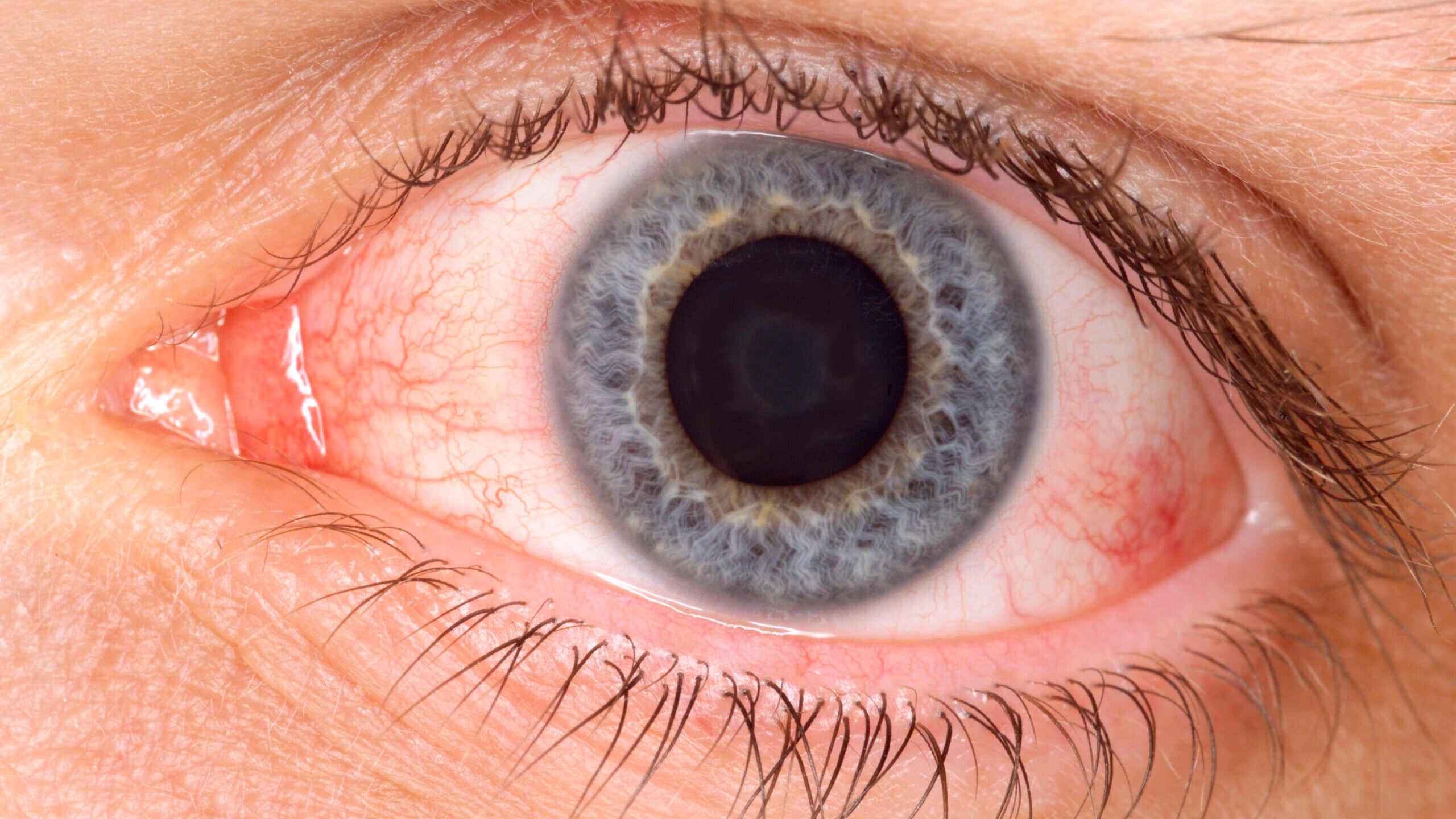 Причины симптома сухого глаза. Конъюнктивальный ксероз. Лимбальный кератоконъюнктивит. Нитчатый кератоконъюнктивит. Роговично-конъюнктивальный ксероз.